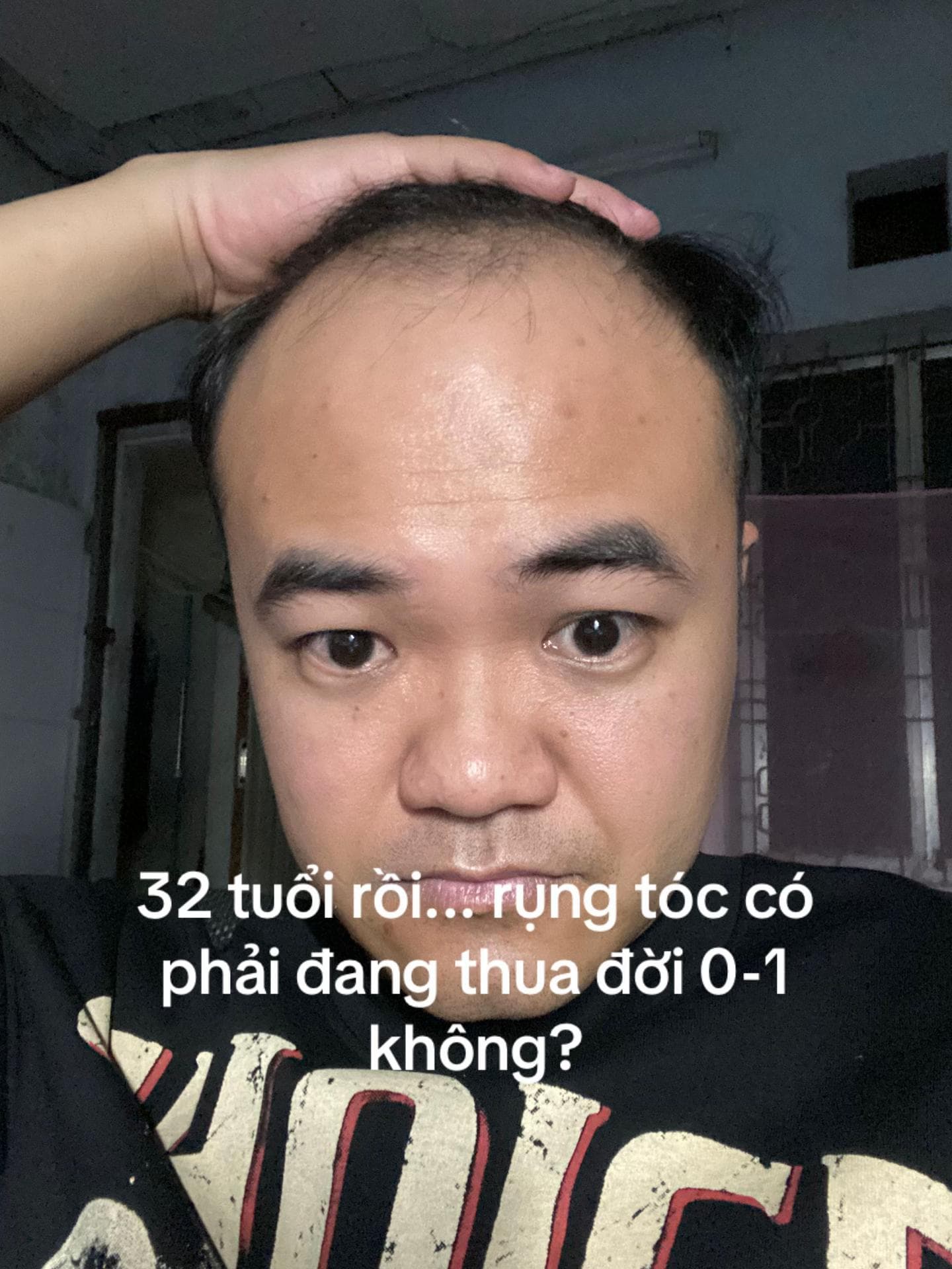 Sơn 32 tuổi vén tóc lộ vùng hói chữ M, 5 ngày trước khi cấy
