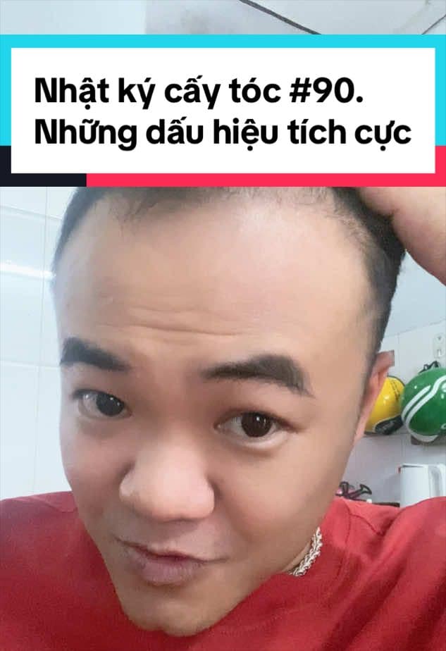 Tóc ngày 90 sau cấy: tóc con nhú lên