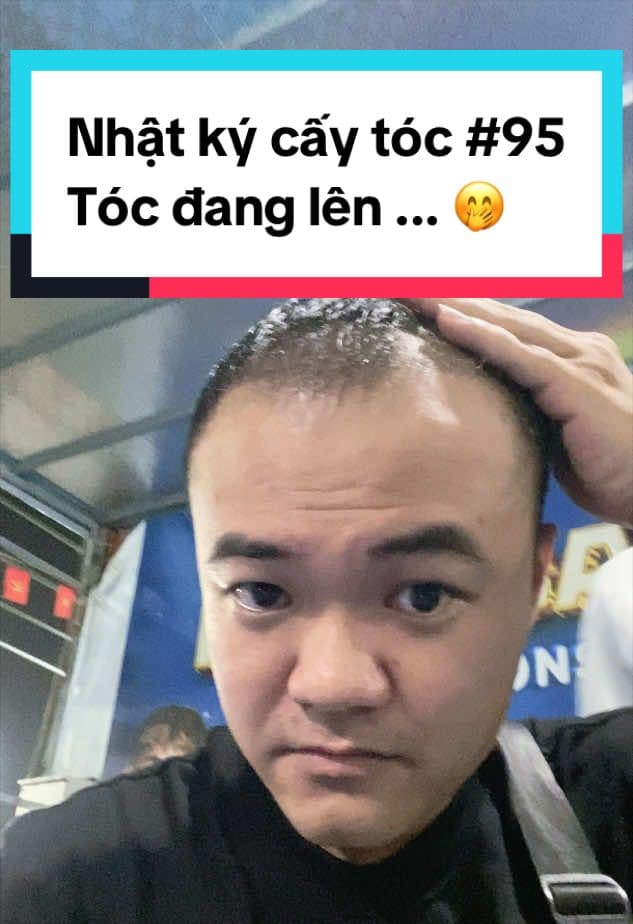 Ngày 95 sau cấy tóc: Tóc đang lên