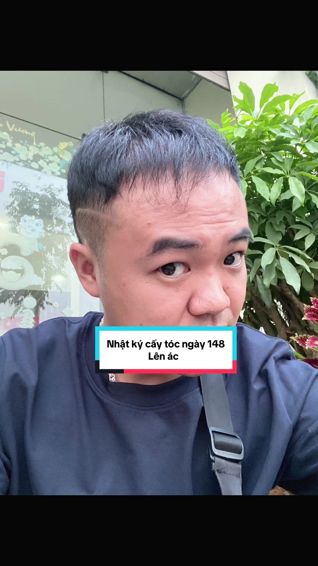 Ngày 148 sau cấy tóc: Lên ác